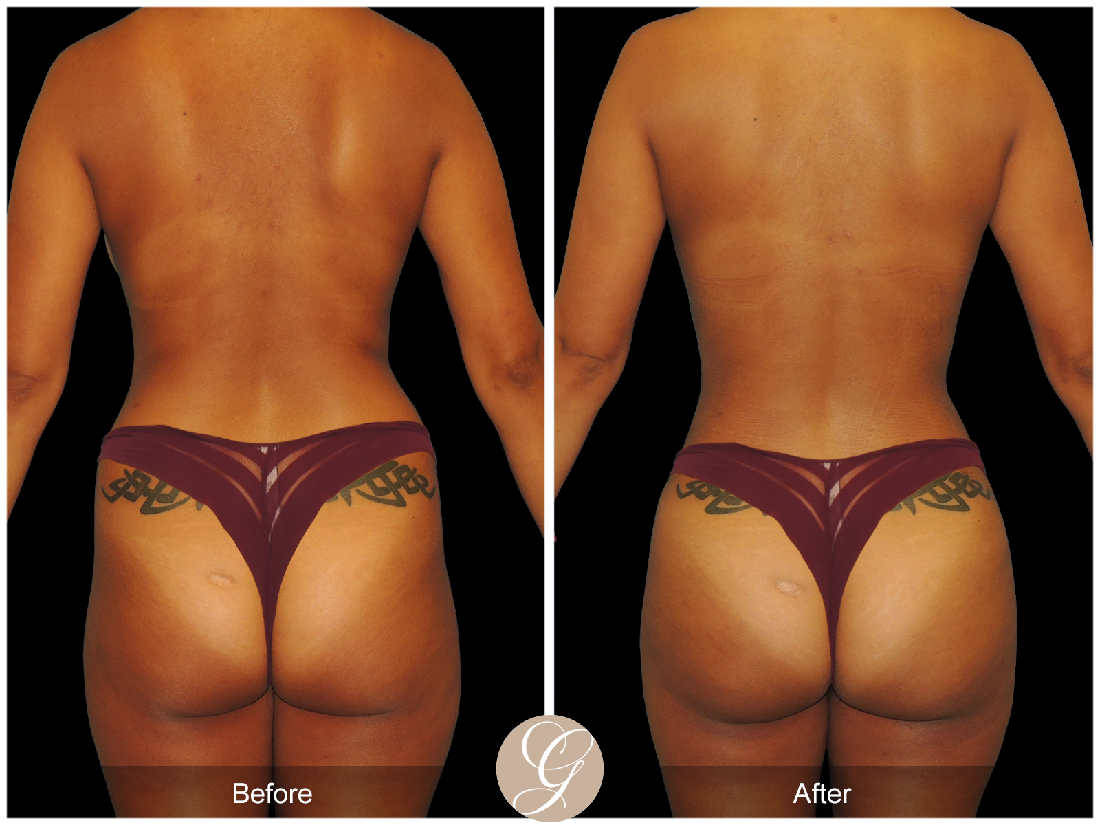 Mommy Makeover PT5 Image