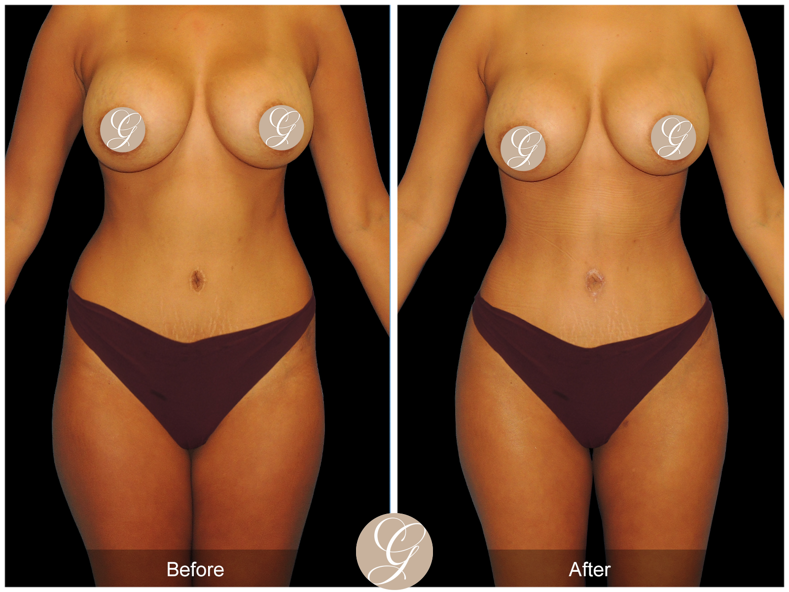 Mommy Makeover PT5 Image