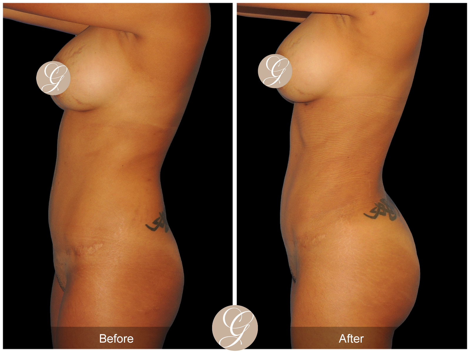 Mommy Makeover PT5 Image