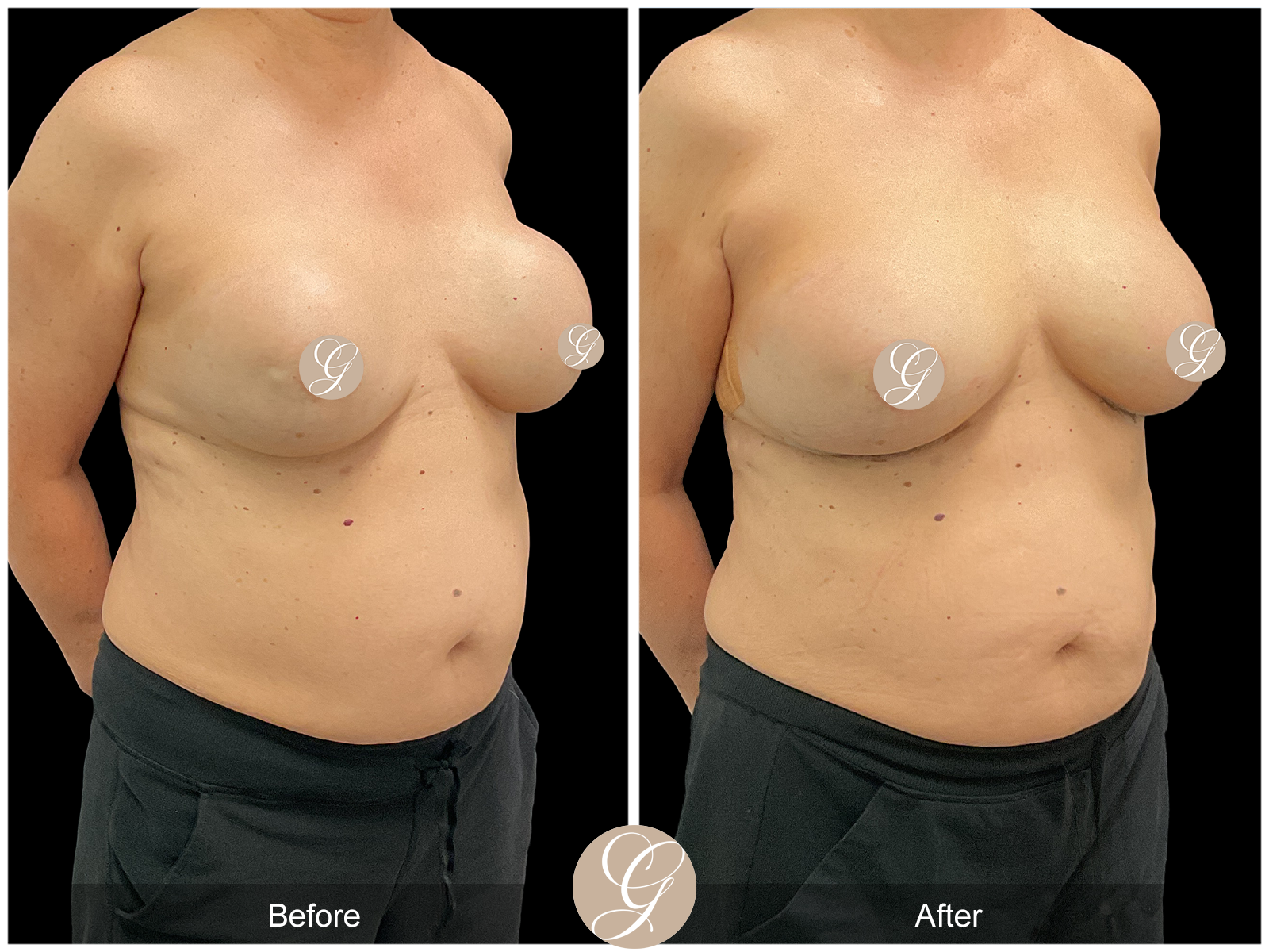 Breast Implant Revision 1 Image