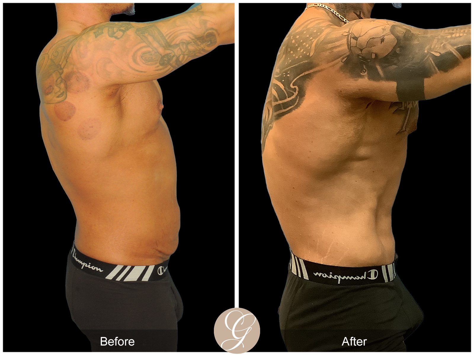 VASER High Definition Surgery for Men PT5 Image