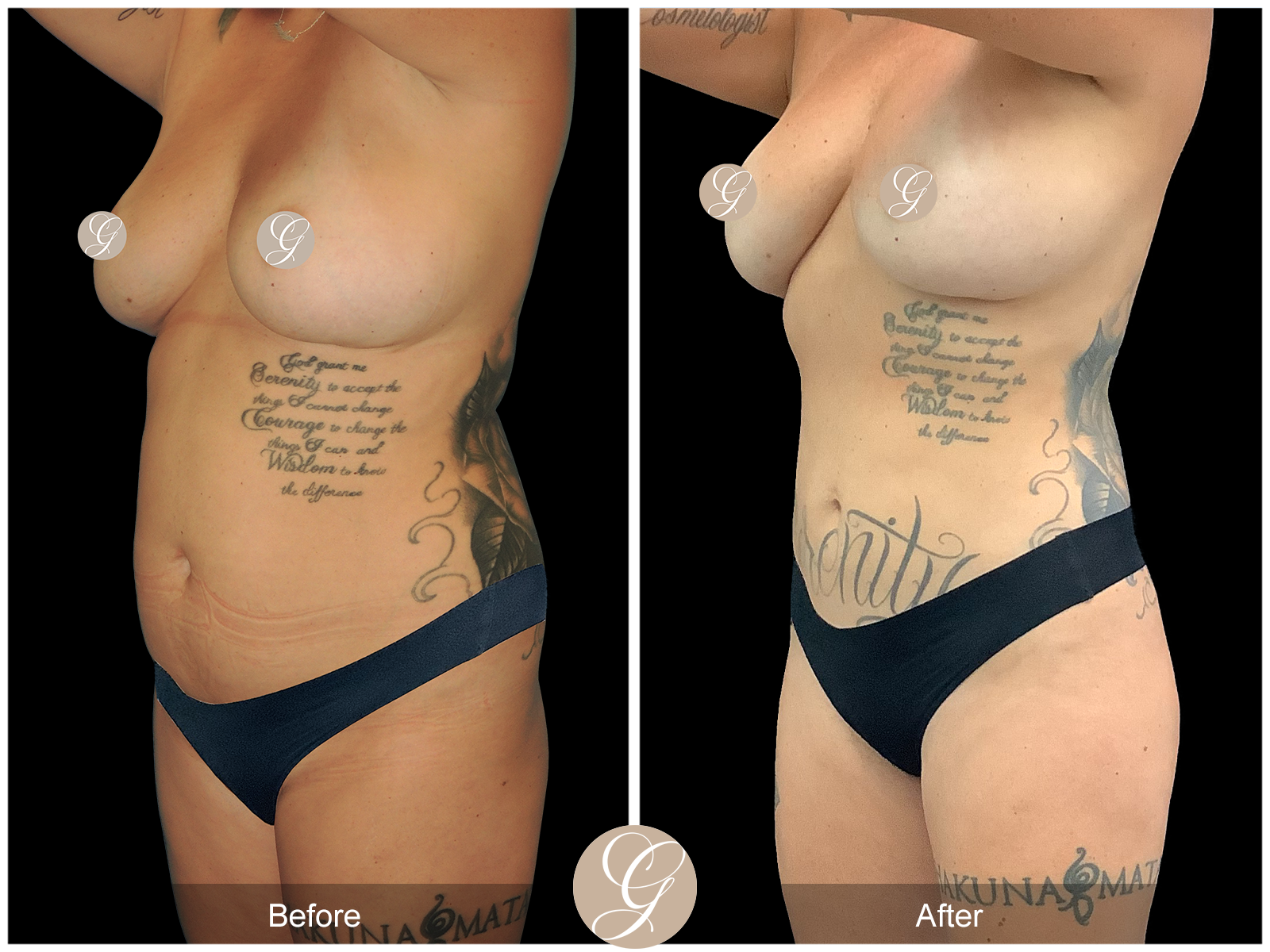 VASER 360 HIGH DEFINITION BODY SCULPTING PT14 Image