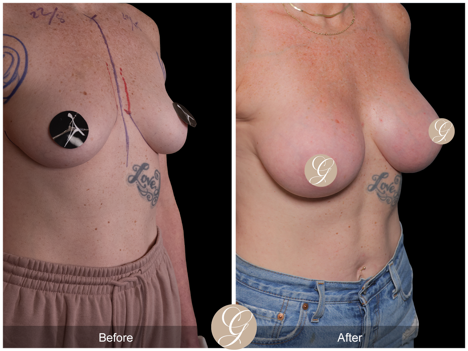 Breast Augmentation Image