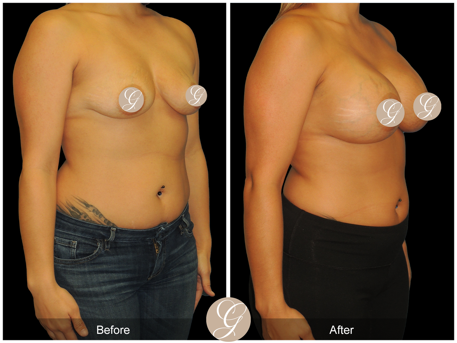 Breast Augmentation PT19 Image