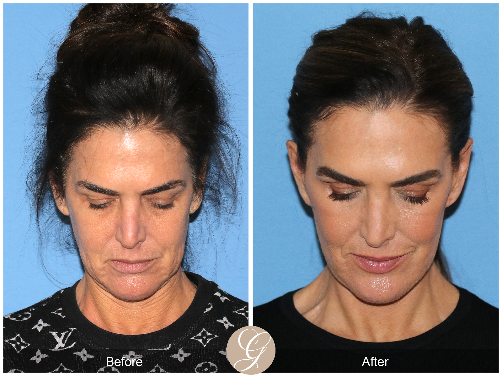 Preservation Facelift Case 1 Image
