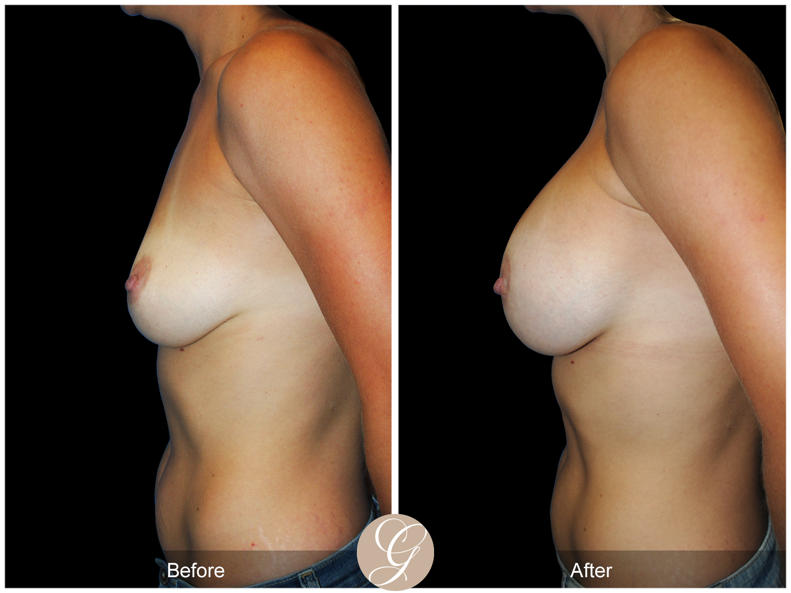 Breast Augmentation PT 21 Image