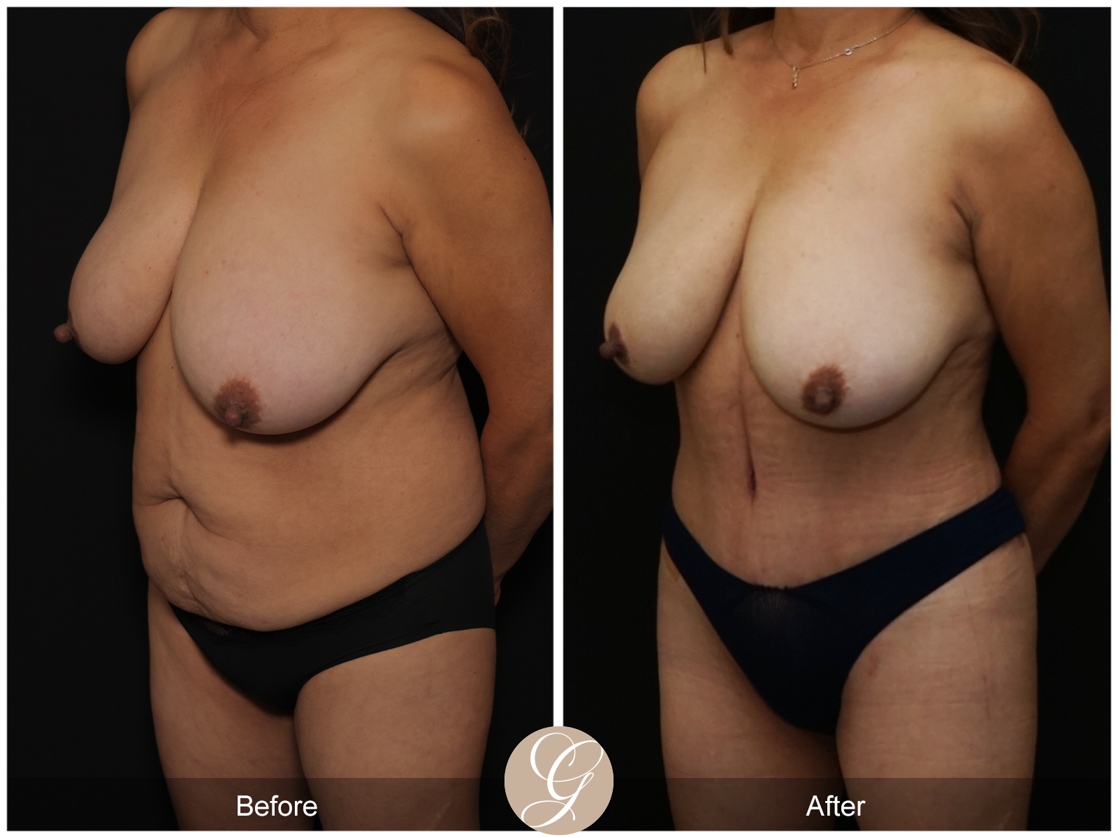 Tummy Tuck Pt 4 Image