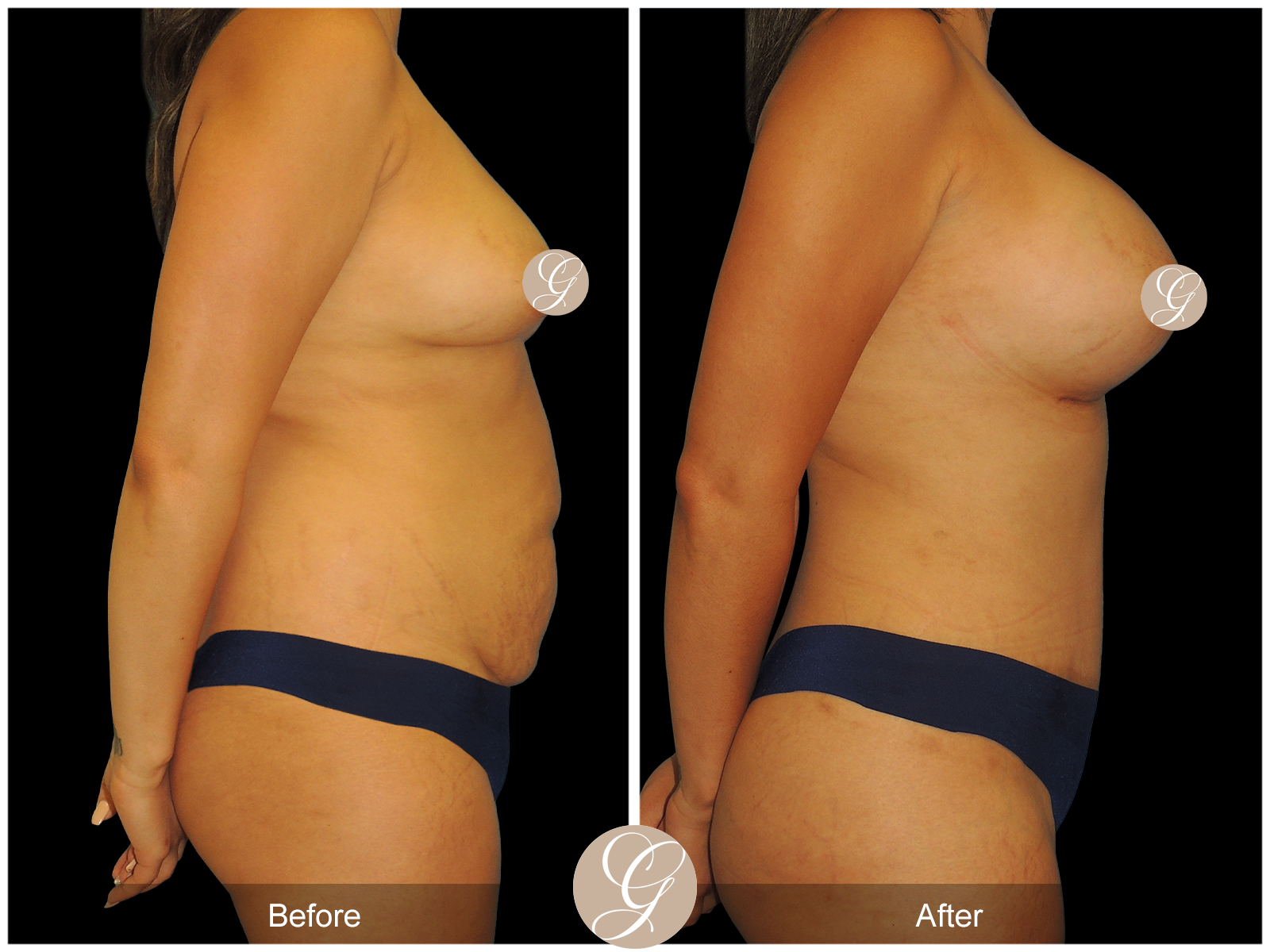 Tummy Tuck PT3 Image