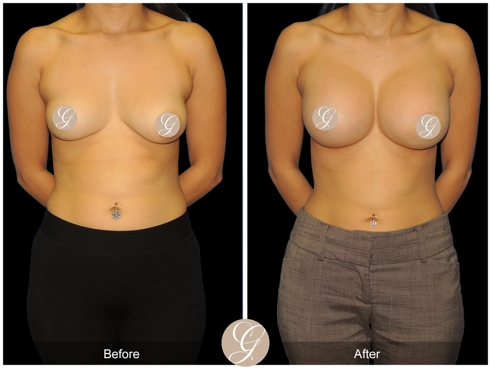 Breast Augmentation PT17 Image