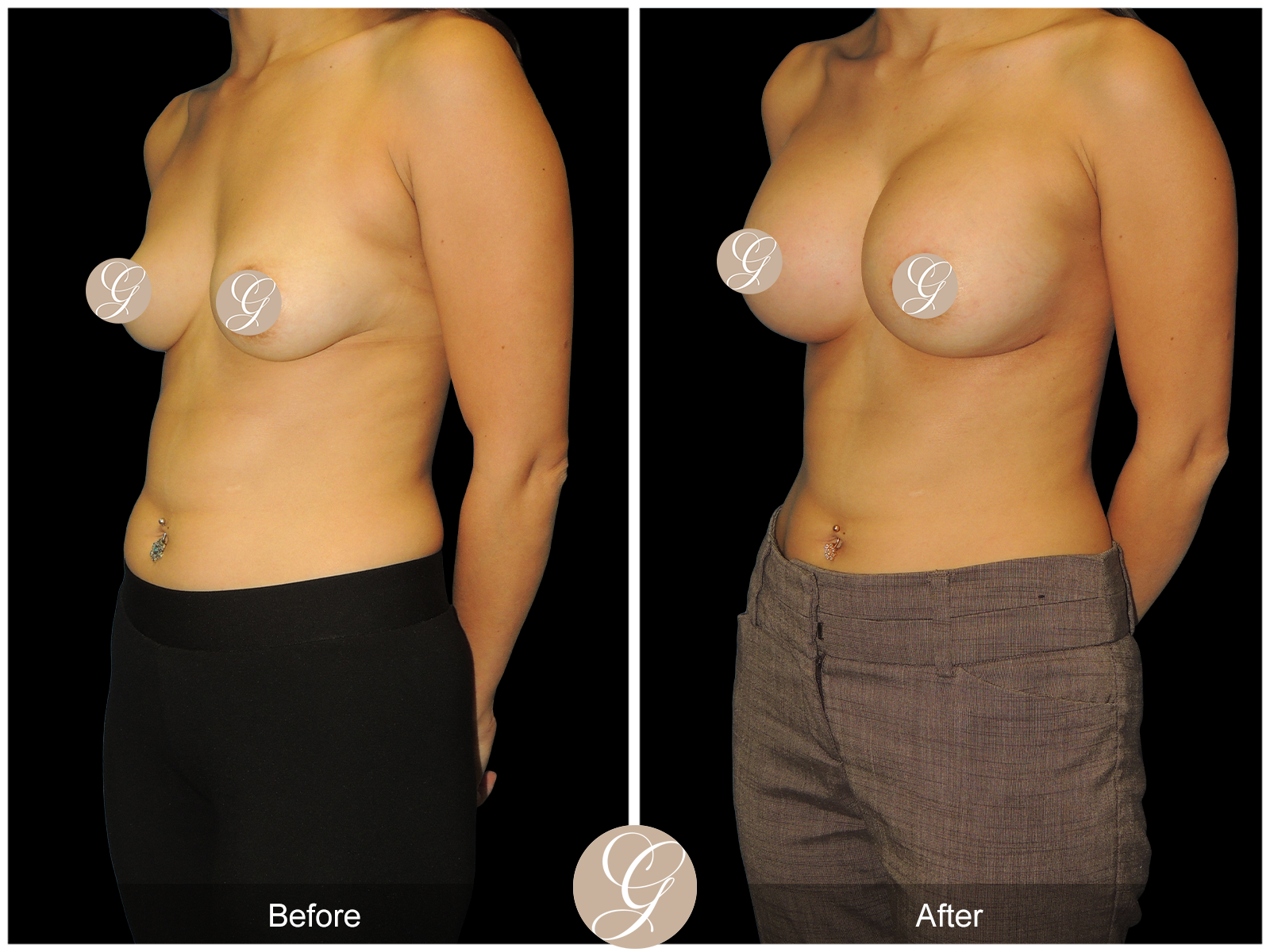 Breast Augmentation PT17 Image