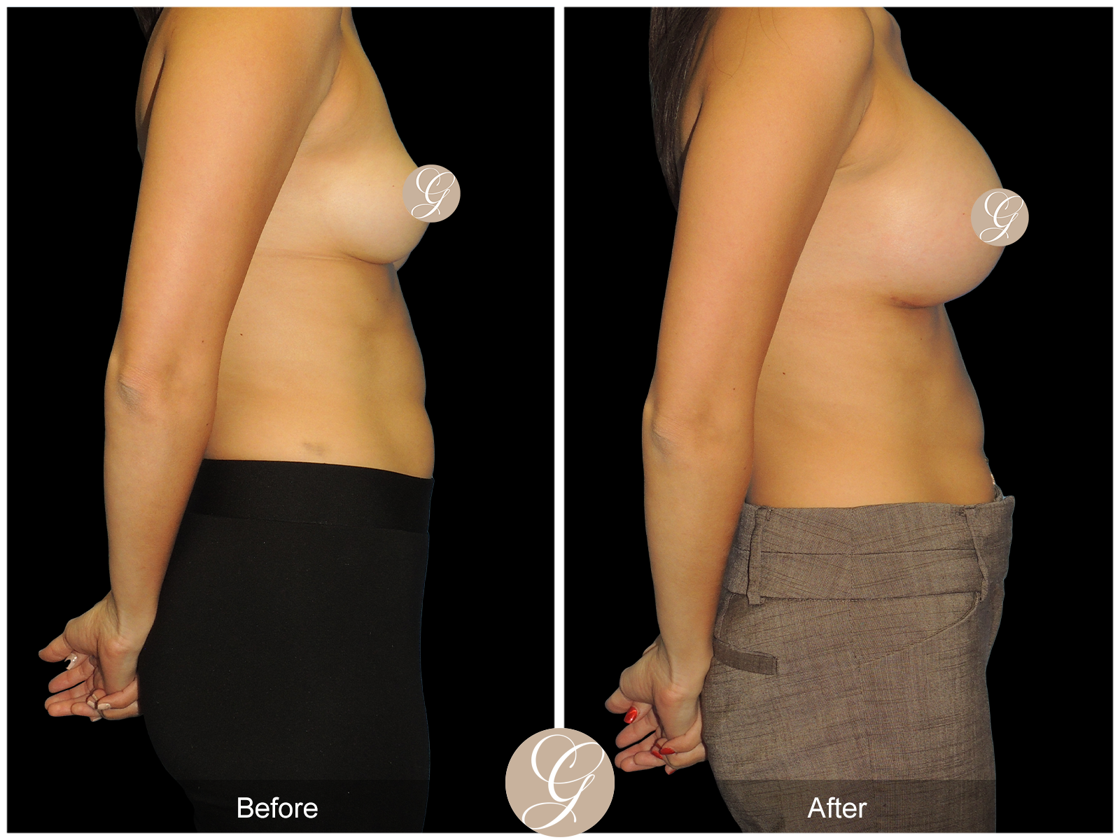 Breast Augmentation PT17 Image