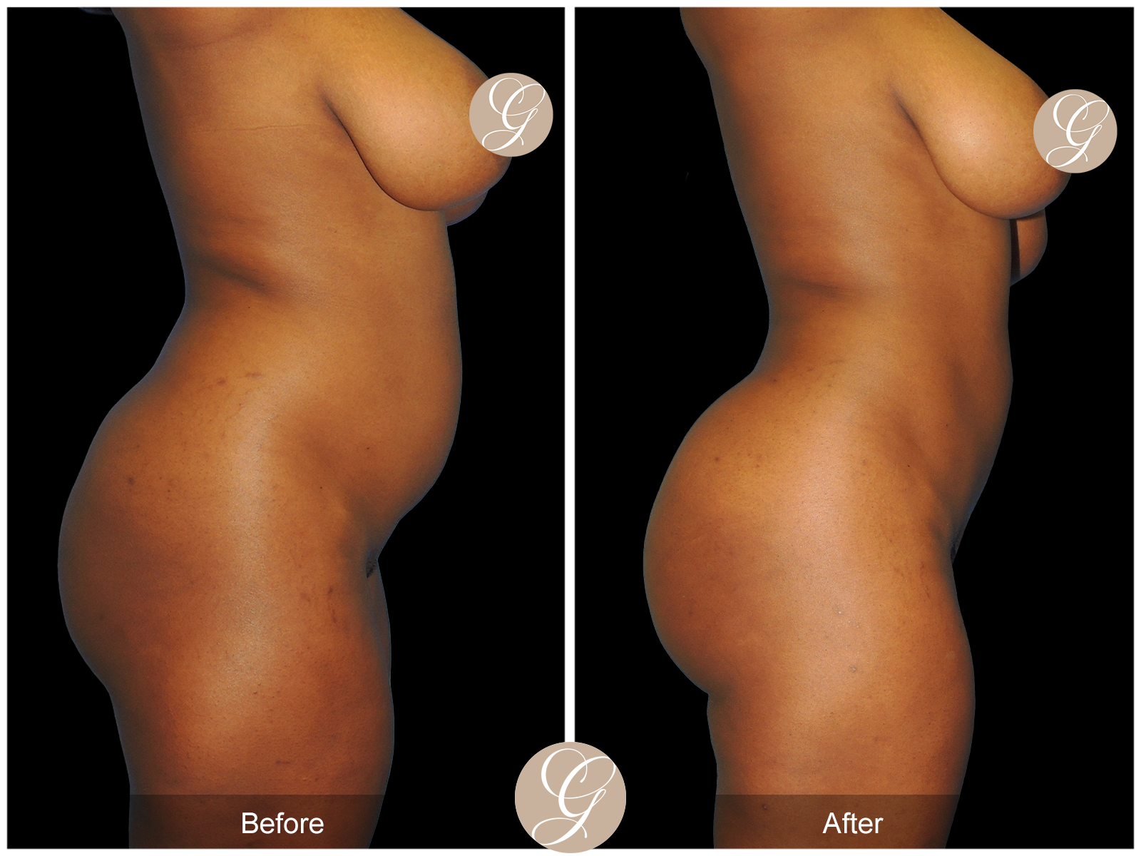 Brazillian Buttock Lift PT1 Image