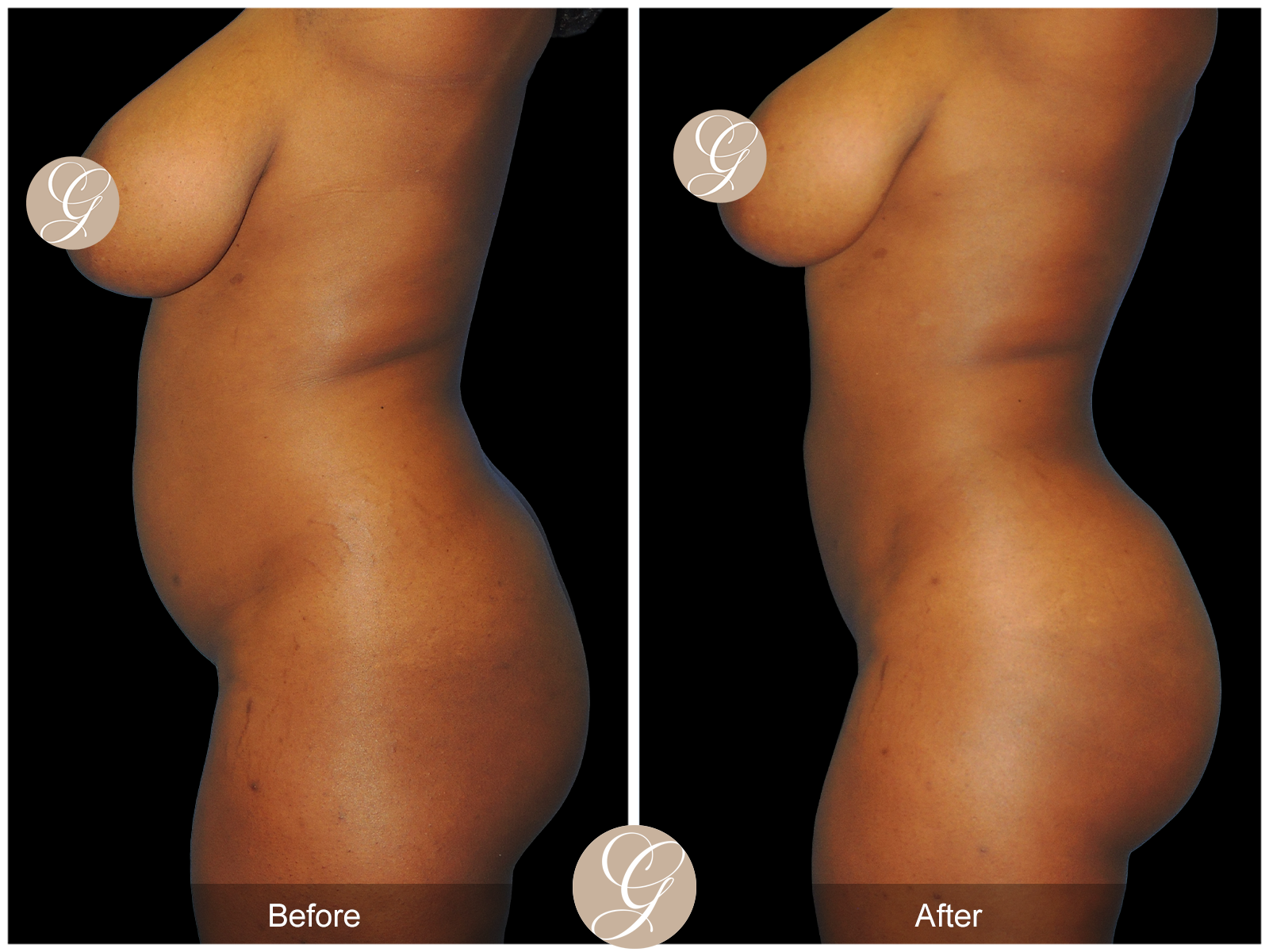 Brazillian Buttock Lift PT1 Image