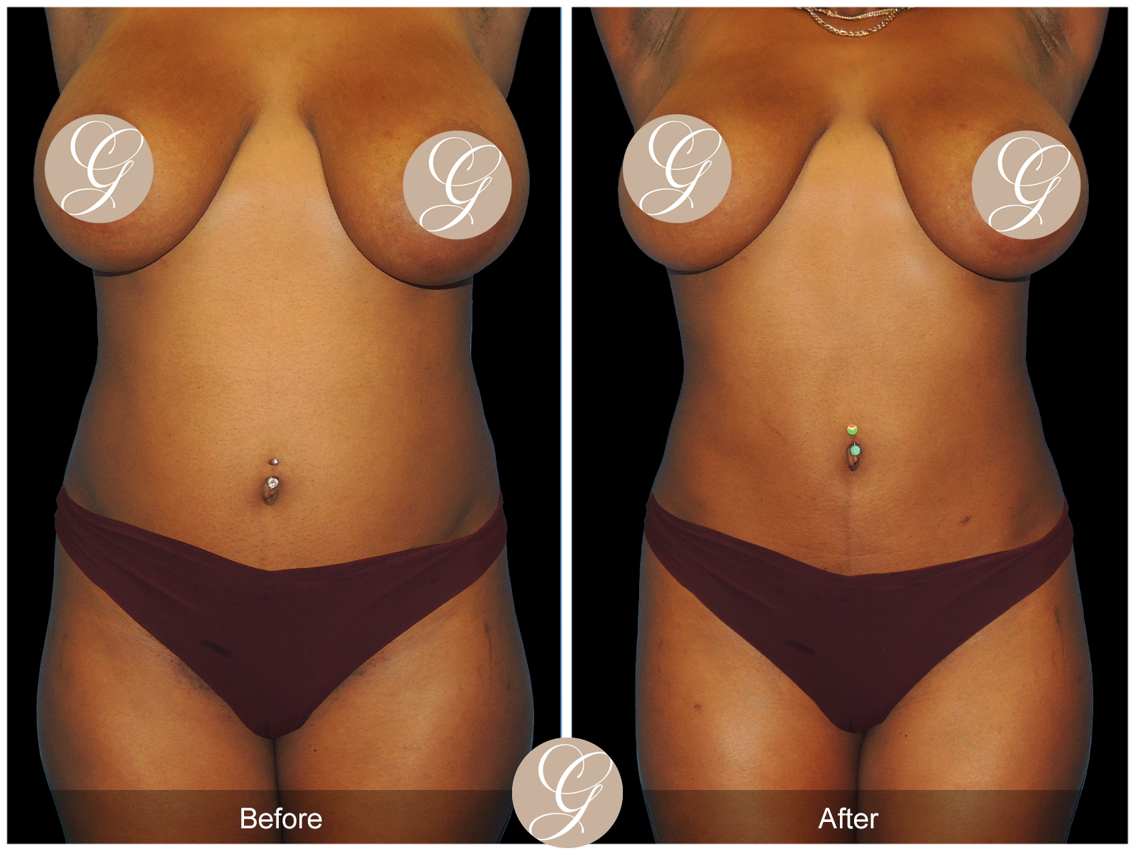 Brazillian Buttock Lift PT1 Image