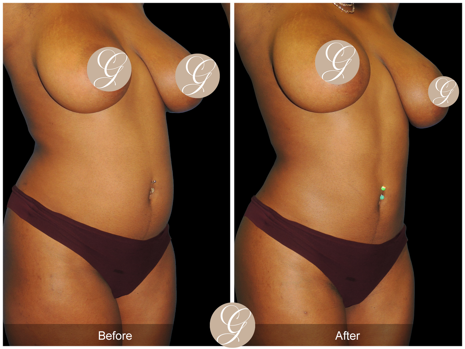 Brazillian Buttock Lift PT1 Image