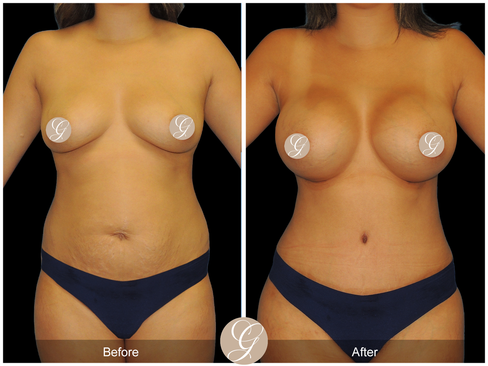 Tummy Tuck PT3 Image