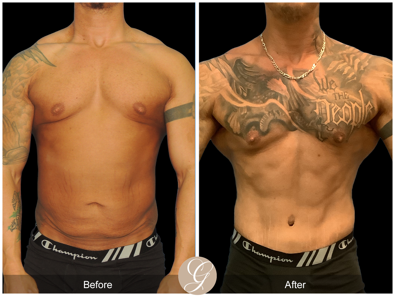 VASER High Definition Surgery for Men PT5 Image