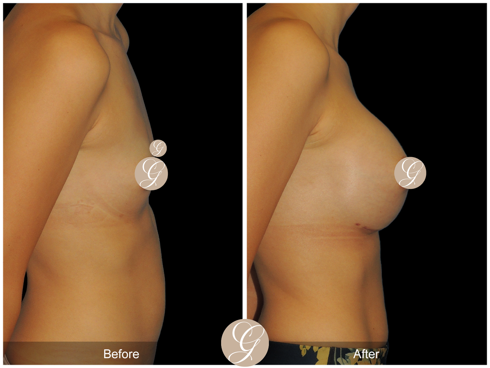 Breast Augmentation with Mesh 1 Image