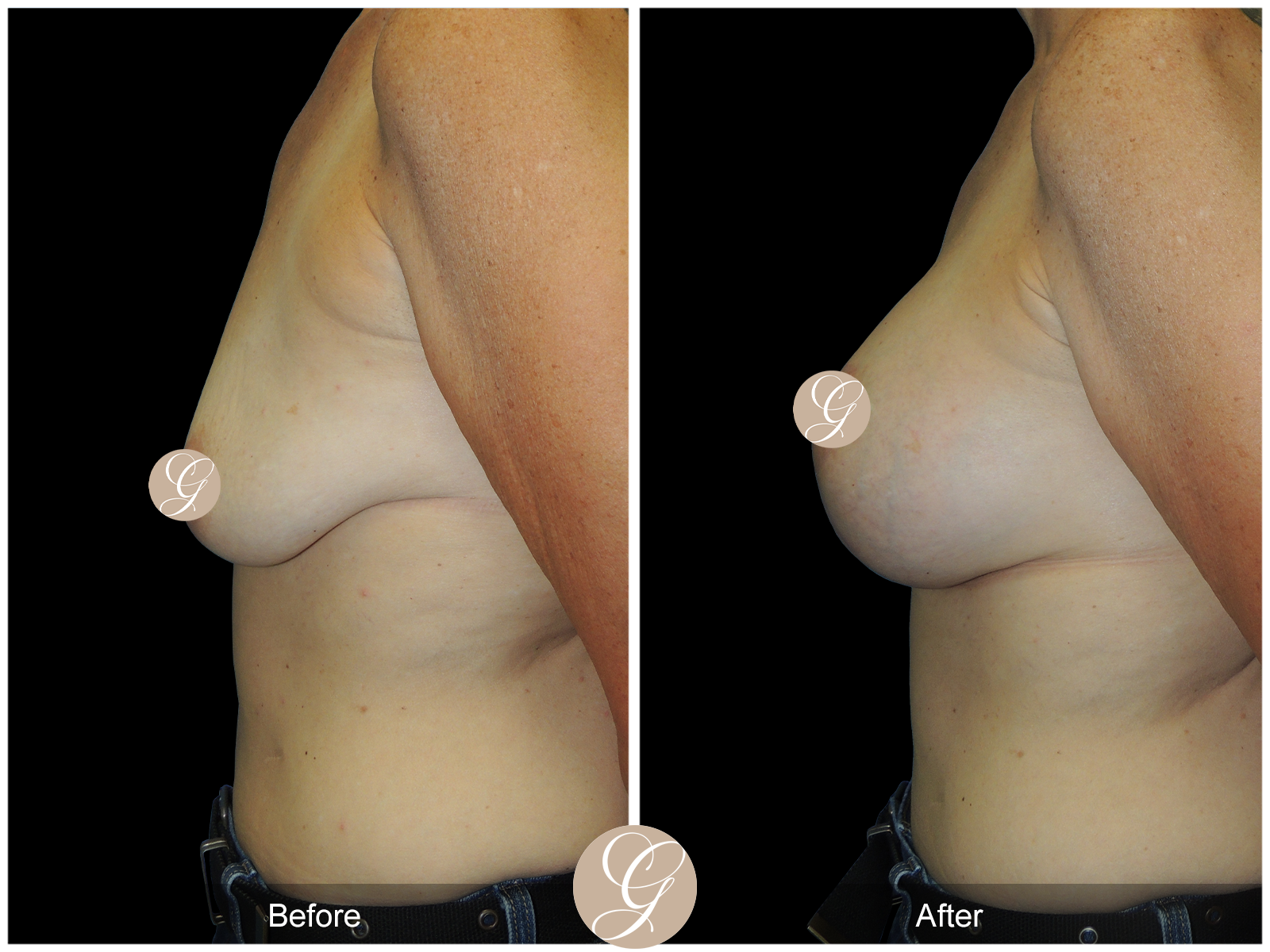 Breast Augmentation with Lift Image