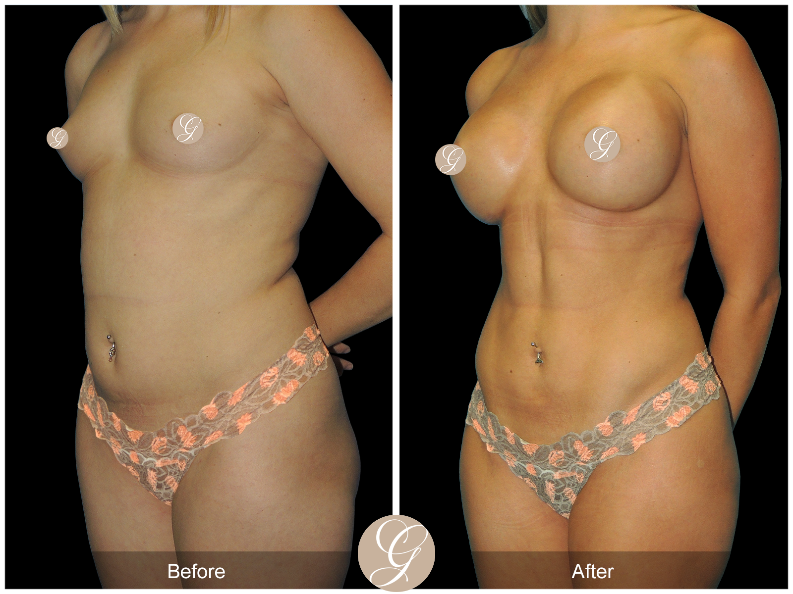 Mommy Makeover PT4 Image