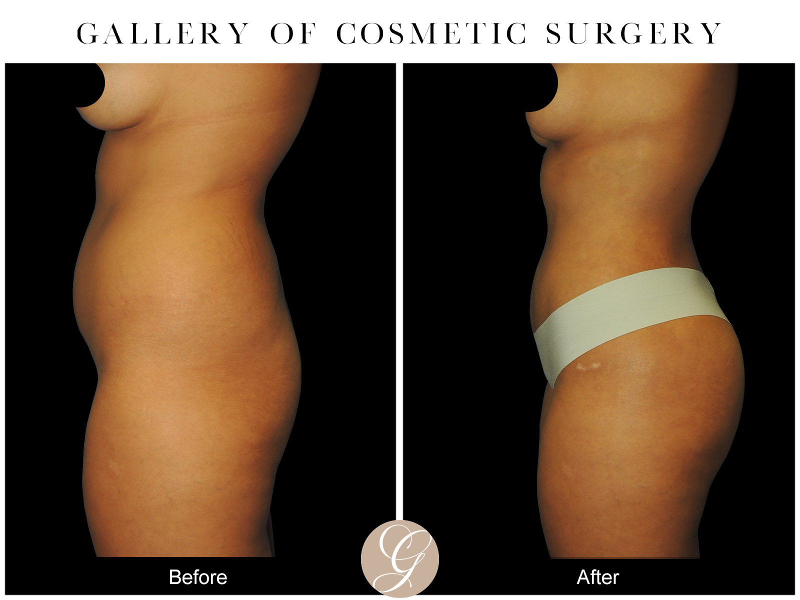 VASER 360 HIGH DEFINITION BODY SCULPTING PT7 Image