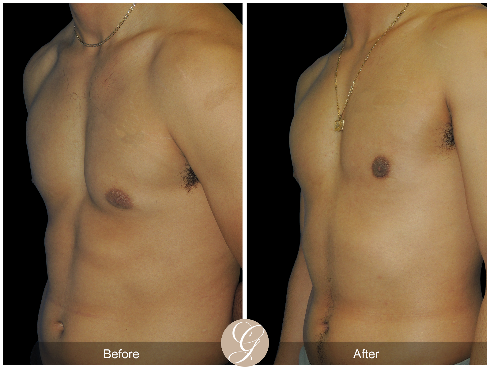 Gynecomastia PT4 Image