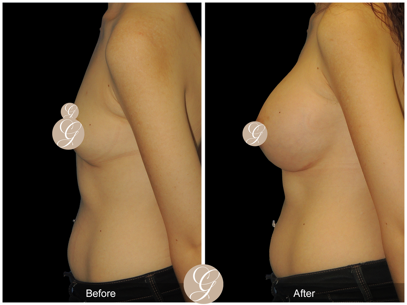 Breast Augmentation with Mesh PT2 Image