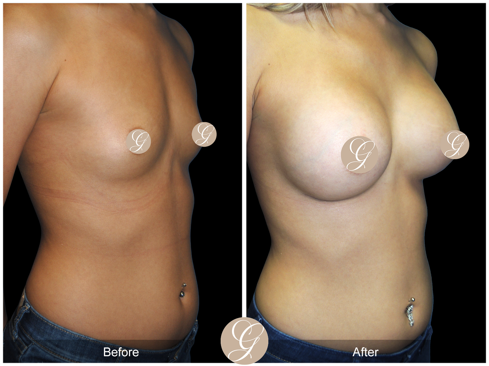 Breast Augmentation PT20 Image