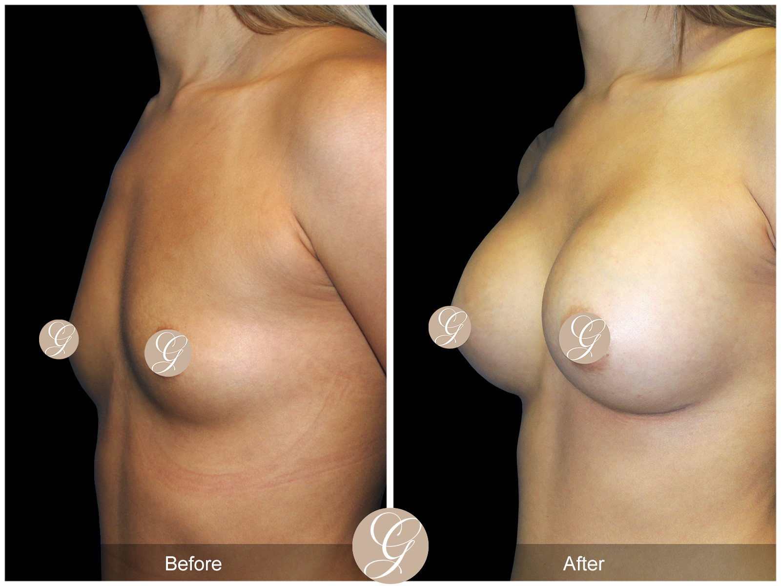 Breast Augmentation PT20 Image