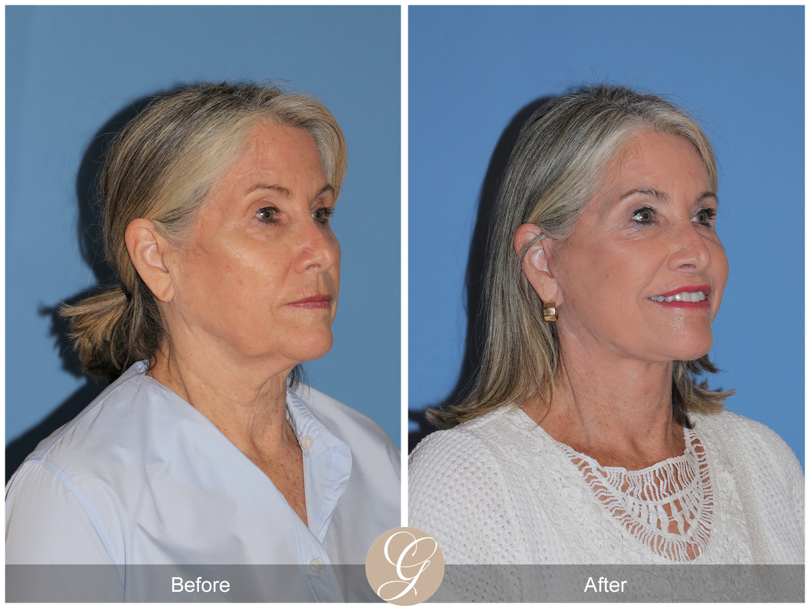 Preservation Facelift Case 21 Image