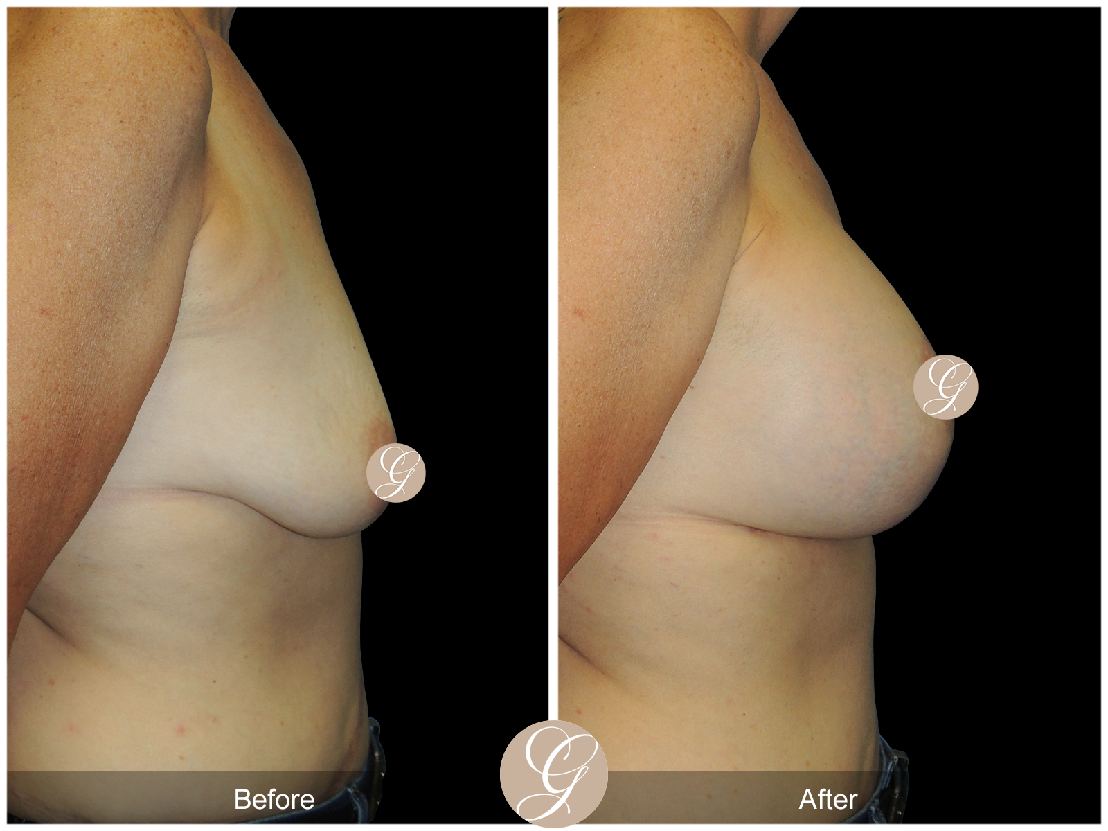 Breast Augmentation with Lift Image