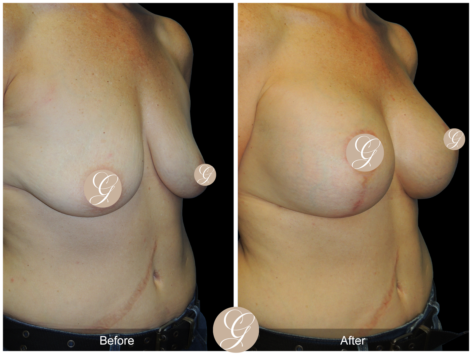 Breast Augmentation with Lift Image