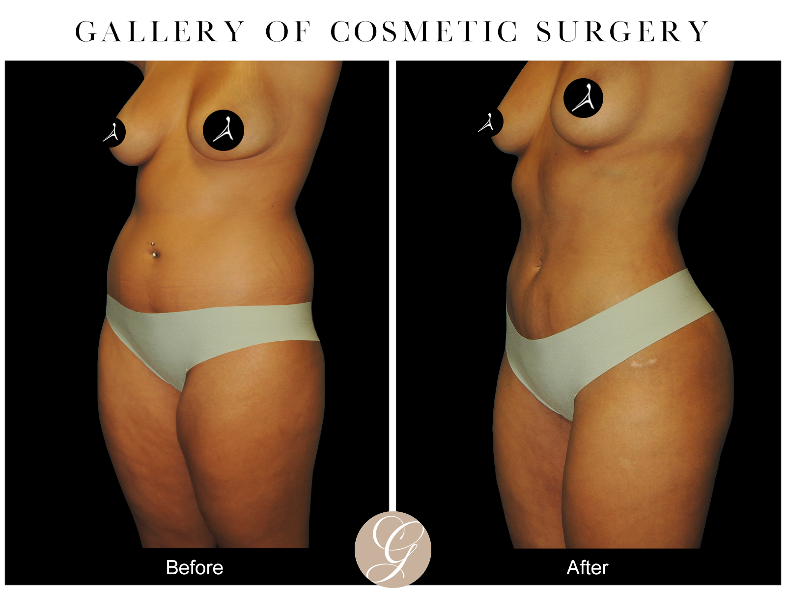 VASER 360 HIGH DEFINITION BODY SCULPTING PT7 Image