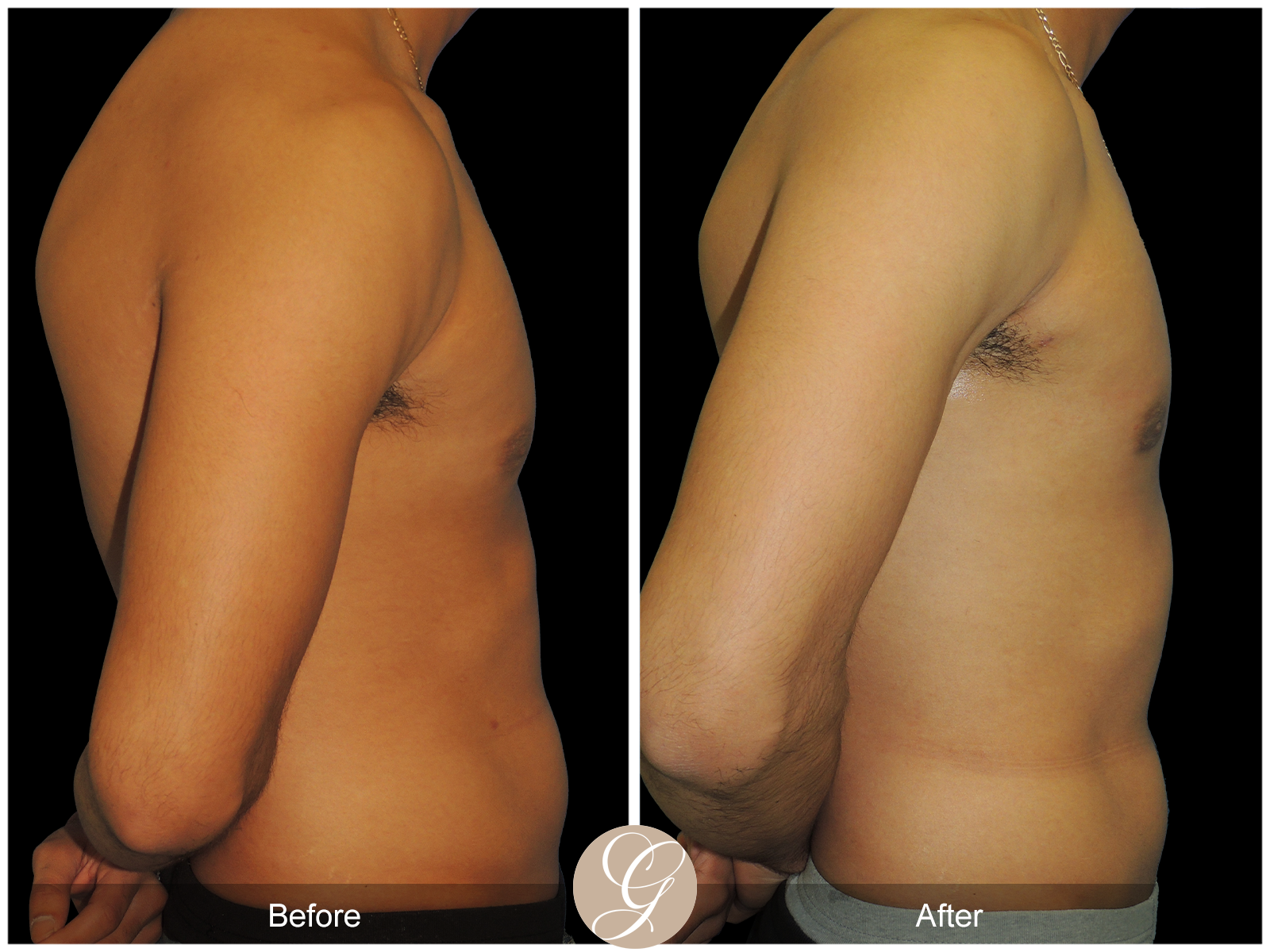 Gynecomastia PT4 Image