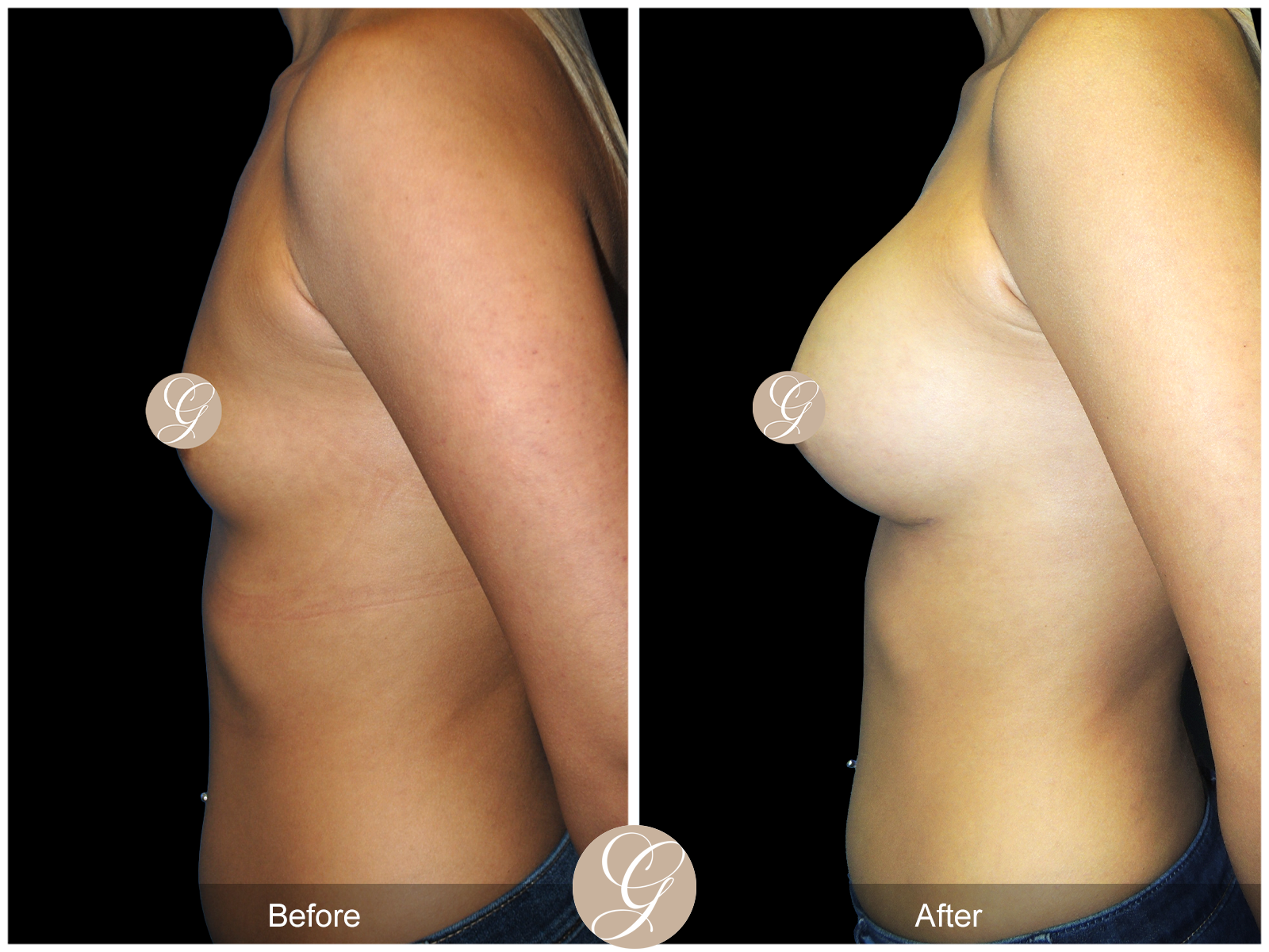 Breast Augmentation PT20 Image