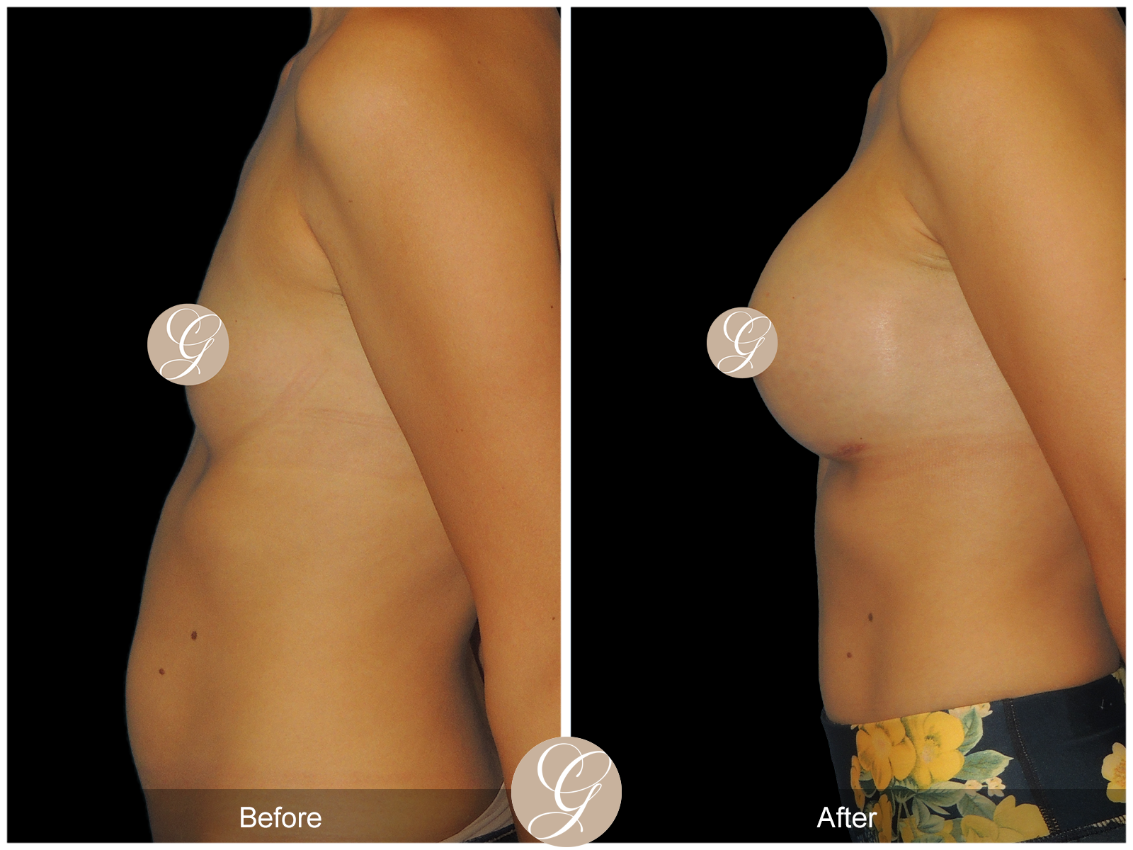 Breast Augmentation with Mesh 1 Image