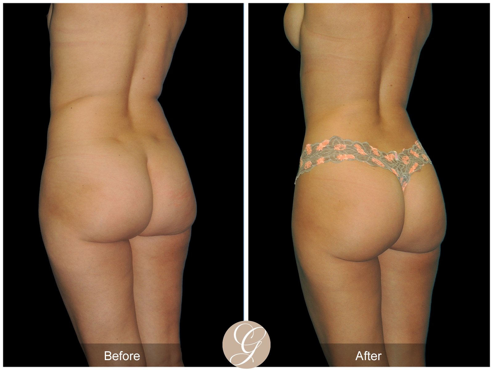 Mommy Makeover PT4 Image