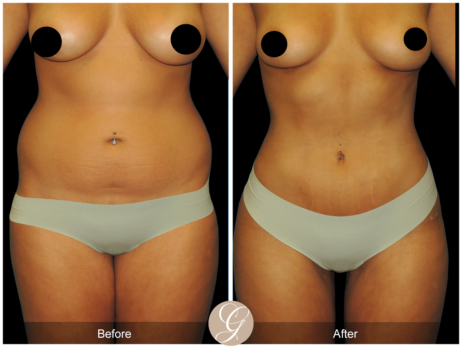 VASER 360 HIGH DEFINITION BODY SCULPTING PT7 Image