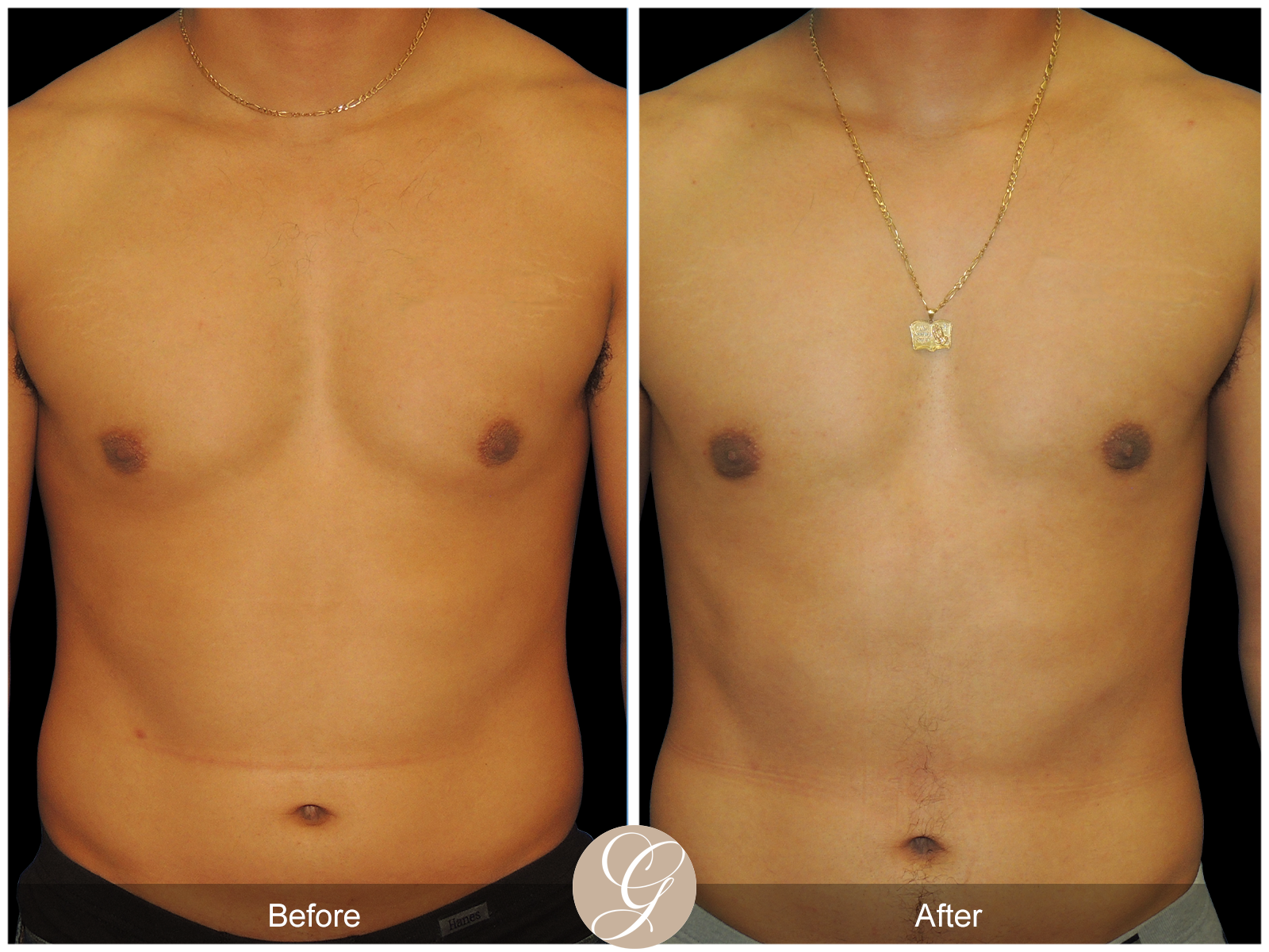 Gynecomastia PT4 Image