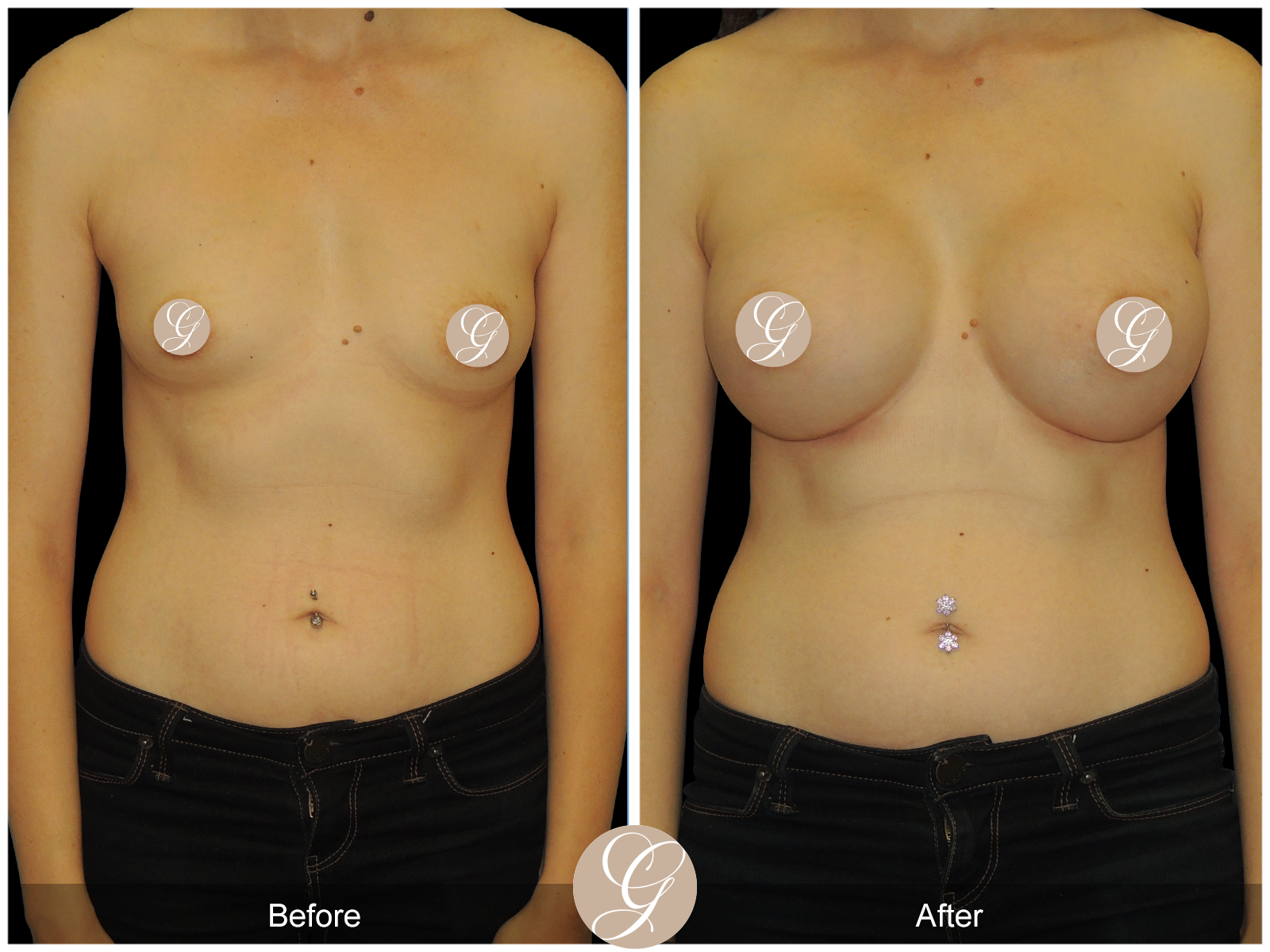 Breast Augmentation with Mesh PT2 Image