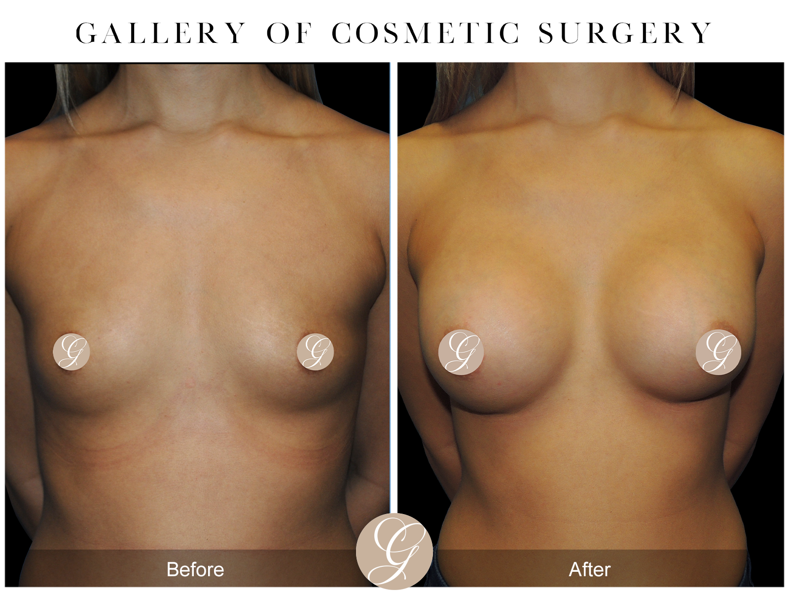 Breast Augmentation PT20 Image