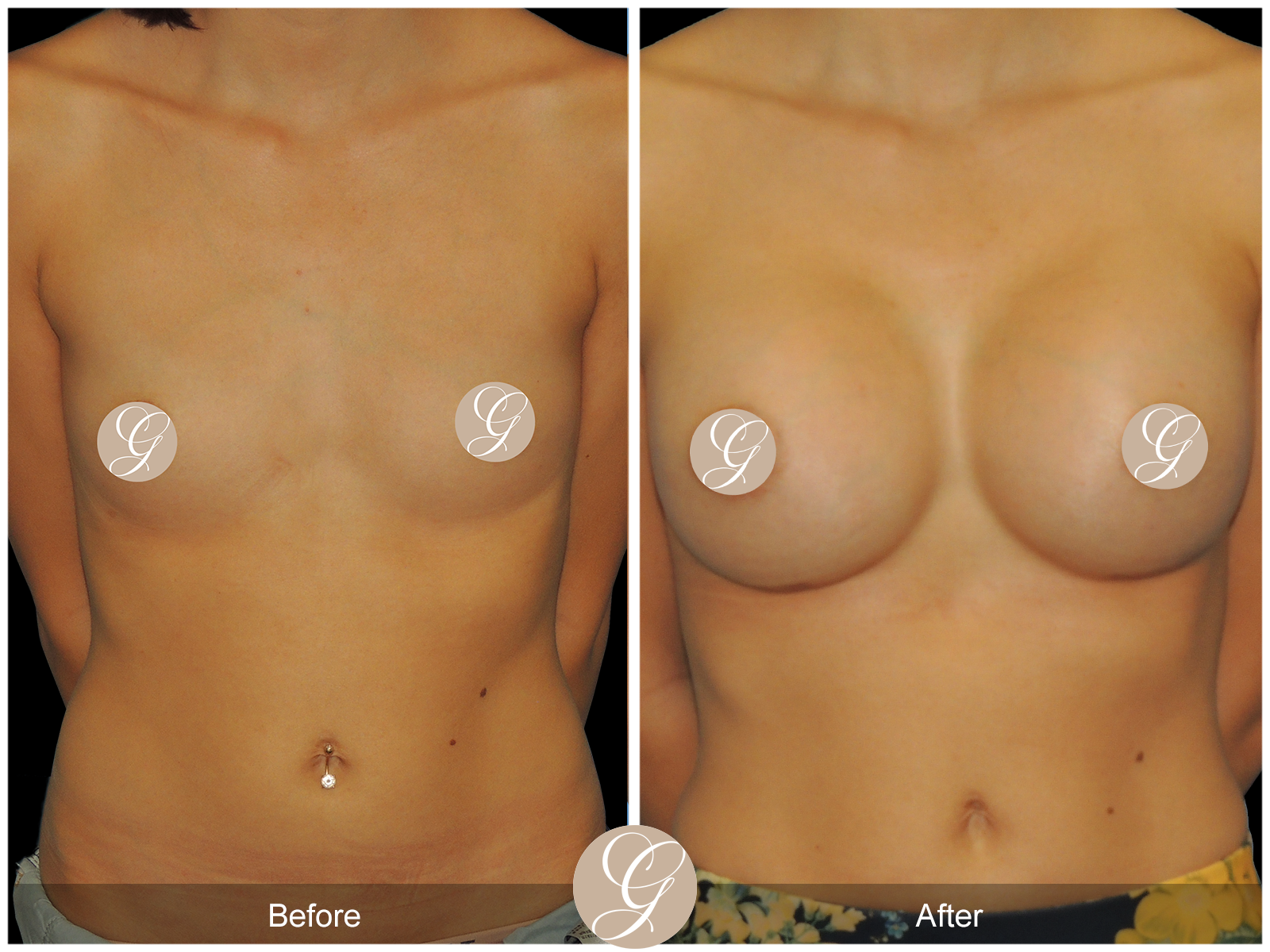 Breast Augmentation with Mesh 1 Image