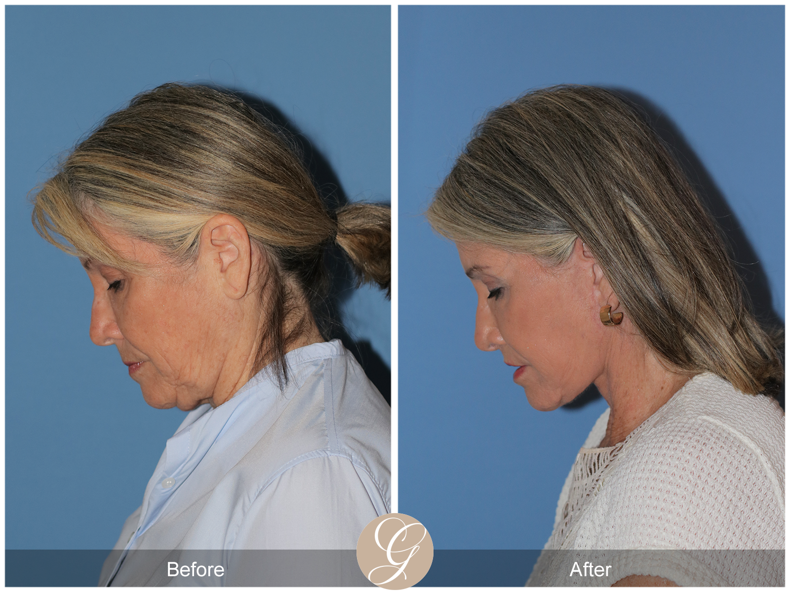 Preservation Facelift Case 21 Image