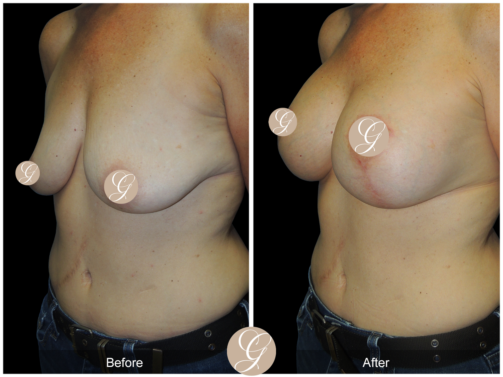 Breast Augmentation with Lift Image