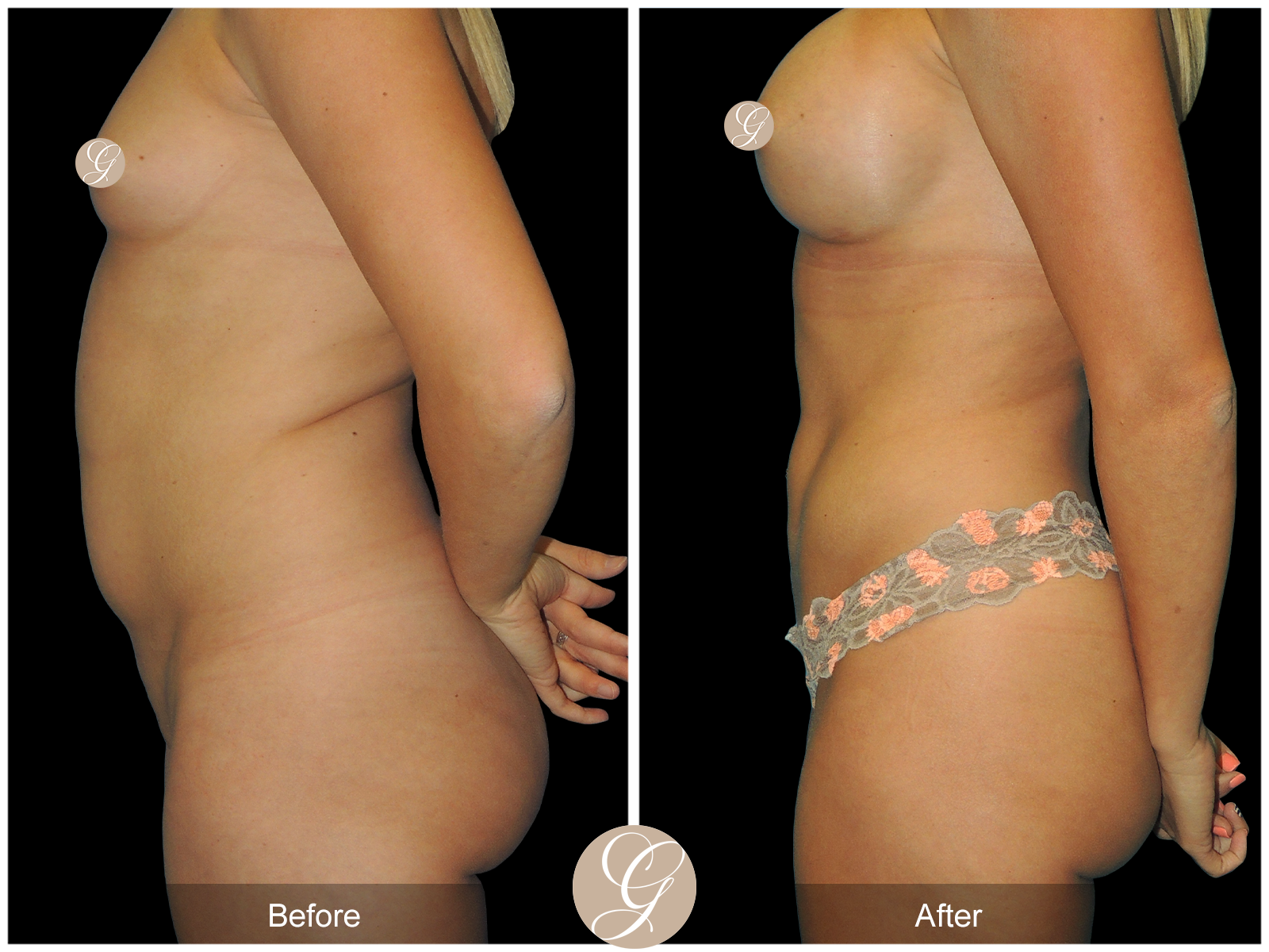 Mommy Makeover PT4 Image