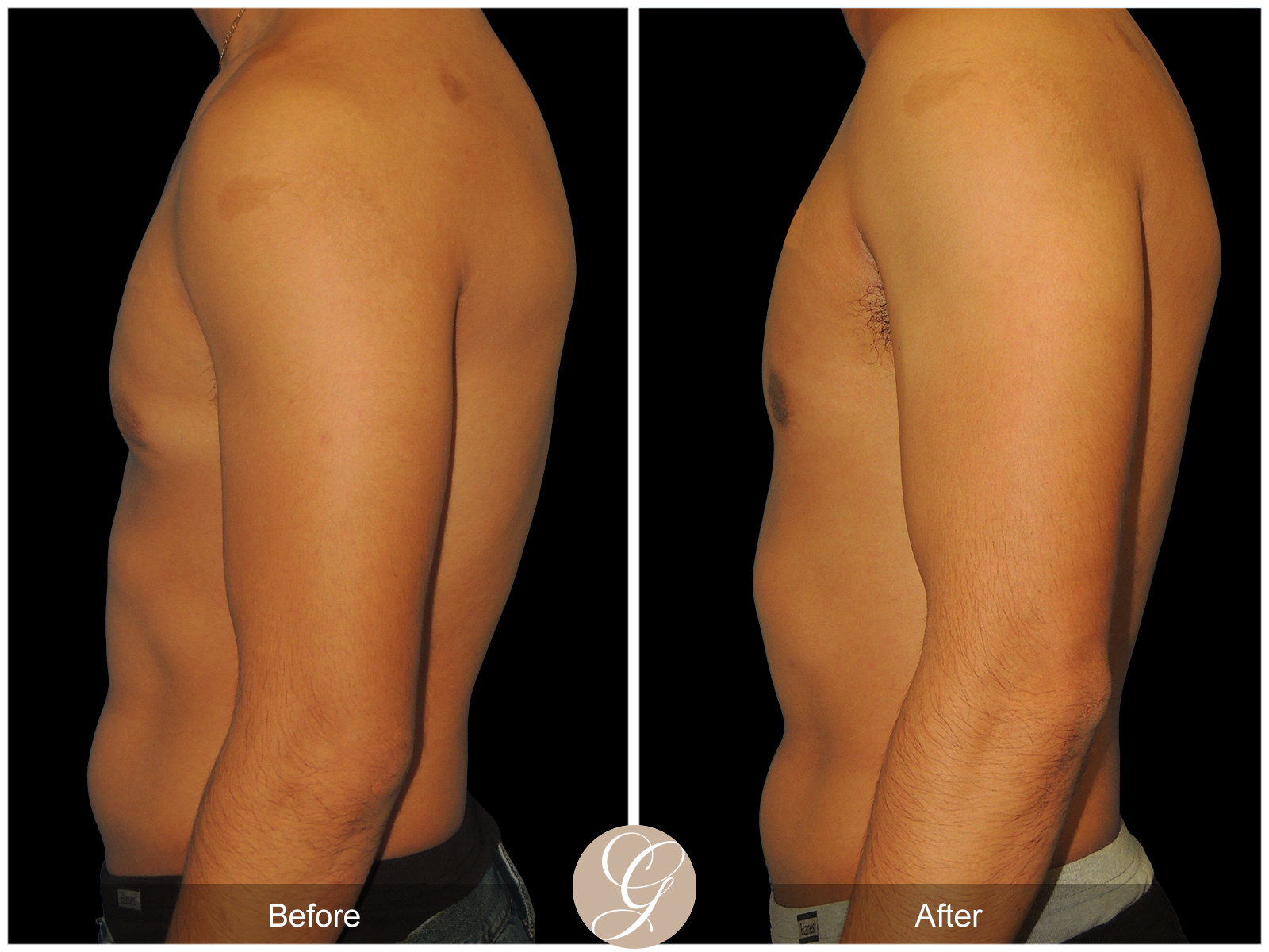 Gynecomastia PT4 Image