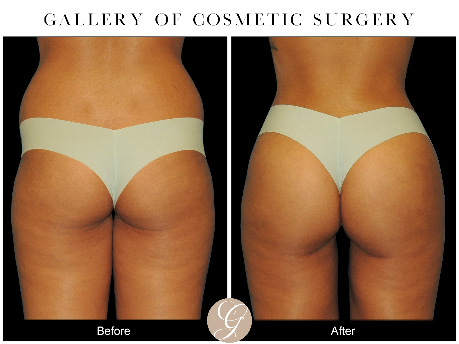 VASER 360 HIGH DEFINITION BODY SCULPTING PT7 Image