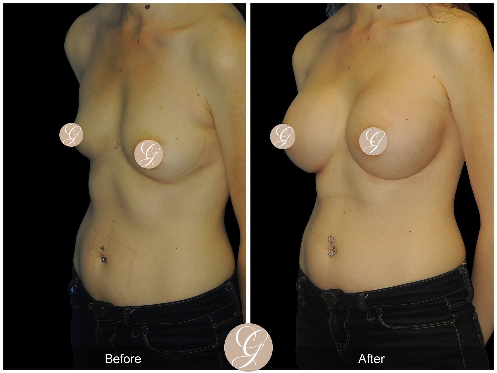 Breast Augmentation with Mesh PT2 Image
