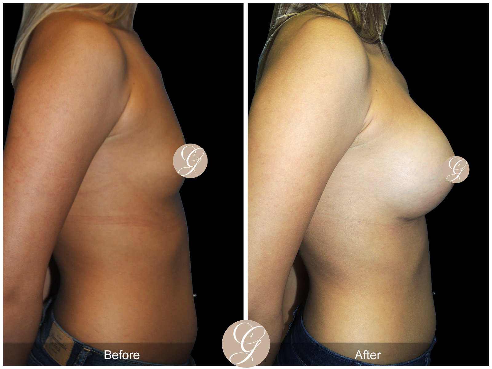 Breast Augmentation PT20 Image