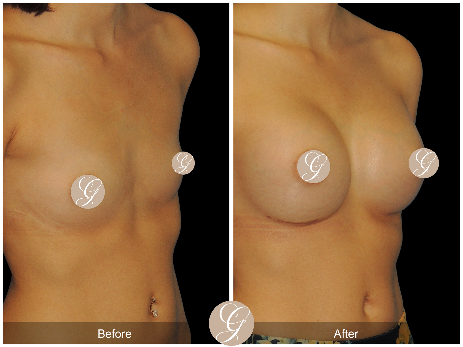 Breast Augmentation with Mesh 1 Image